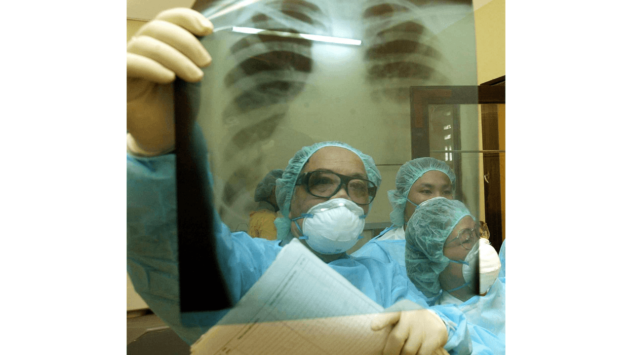 Se le llama síndorme de pulmón blanco por las manchas blancas que se observan en las radiografías de pulmones de personas con neumonía.