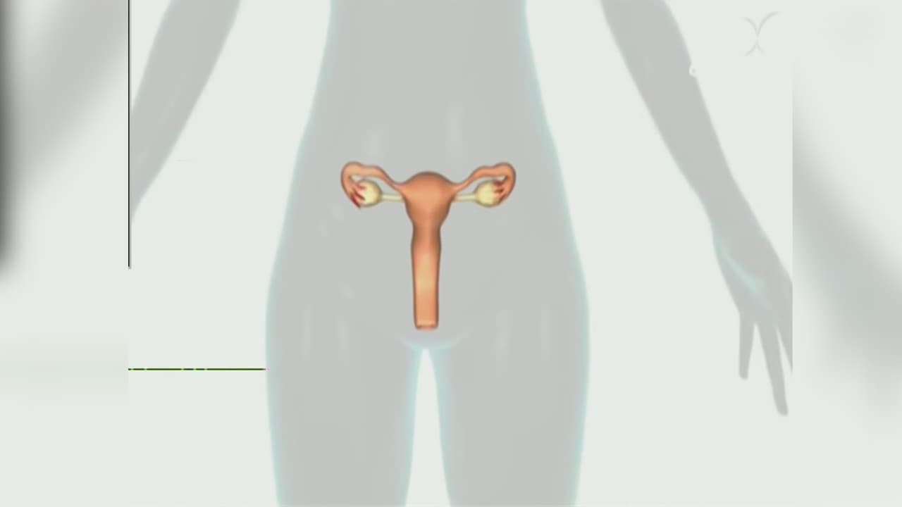 Quitar las trompas de Falopio ayuda a prevenir el cáncer de ovario: explicamos a qué mujeres se les recomienda