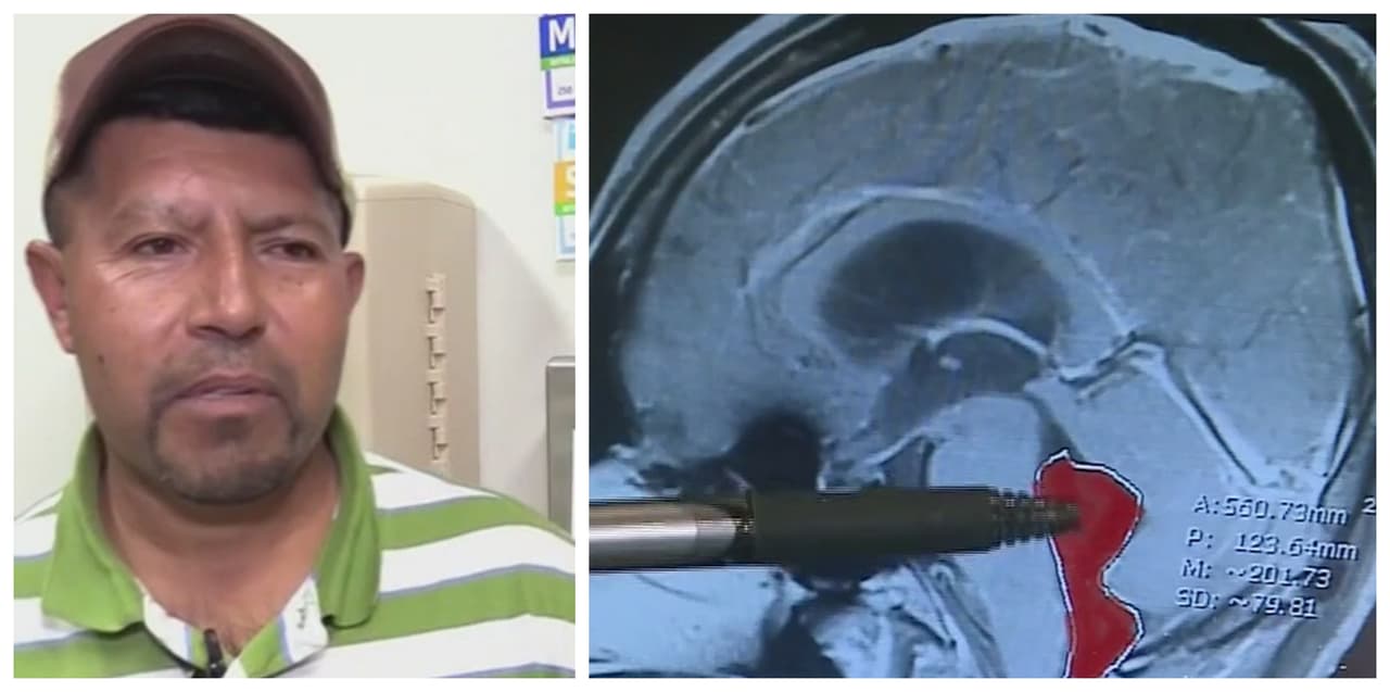 Hispano sufría intensos dolores de cabeza y descubrió más tarde que tenía un parásito viviendo en su cerebro 