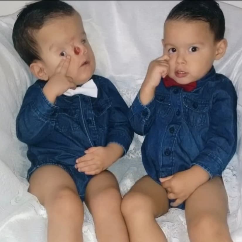 Desde ese día, Luna se ha cuestionado por qué Thiago nació con esa malformación, 
<b>mientras que su hermano gemelo lo hizo con una salud plena.</b> Hasta el momento, los doctores no han encontrado nada científicamente que pueda resolver esa duda. 
<br>