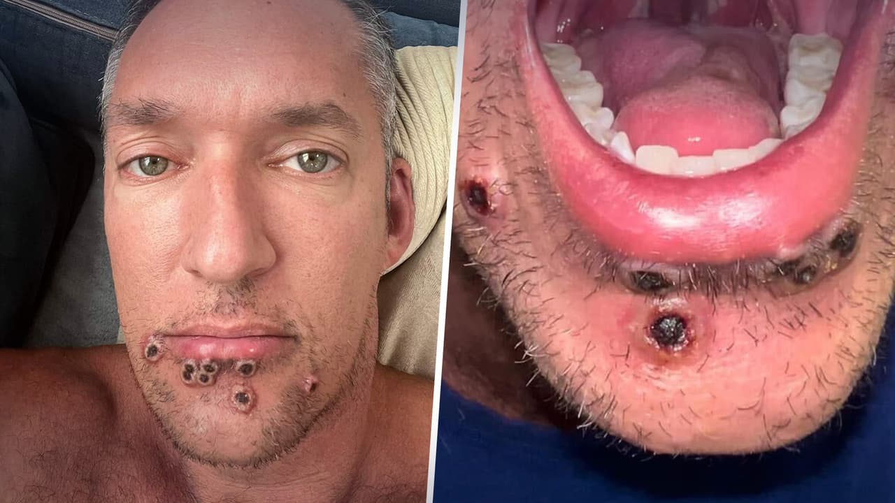 A principios de semana, hubo 34 contagios en Houston y ante el incremento de casos el Departamento de Salud del Condado Harris habilitó una línea exclusiva para informar sobre la viruela del mono y es el
<b> 832-927-0707.</b>