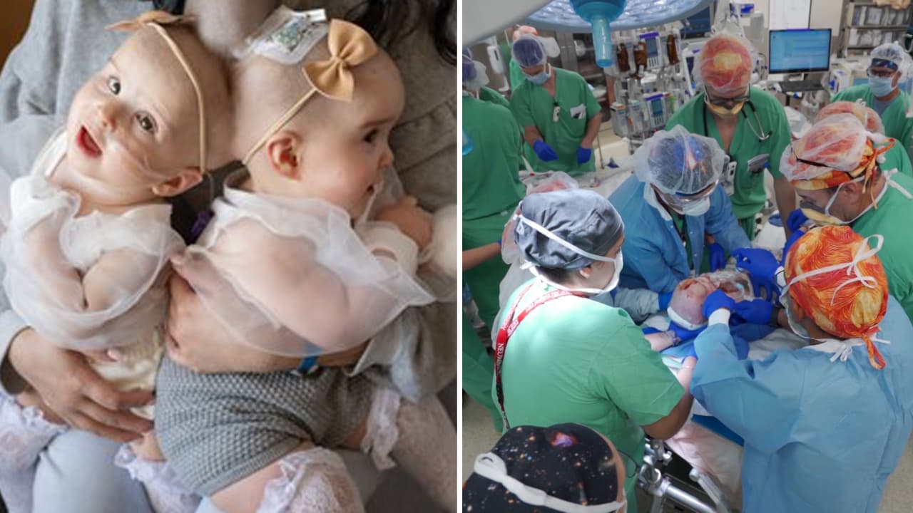 Separan con éxito a mellizas unidas por la cabeza tras una cirugía de 24 horas en un hospital de Sacramento