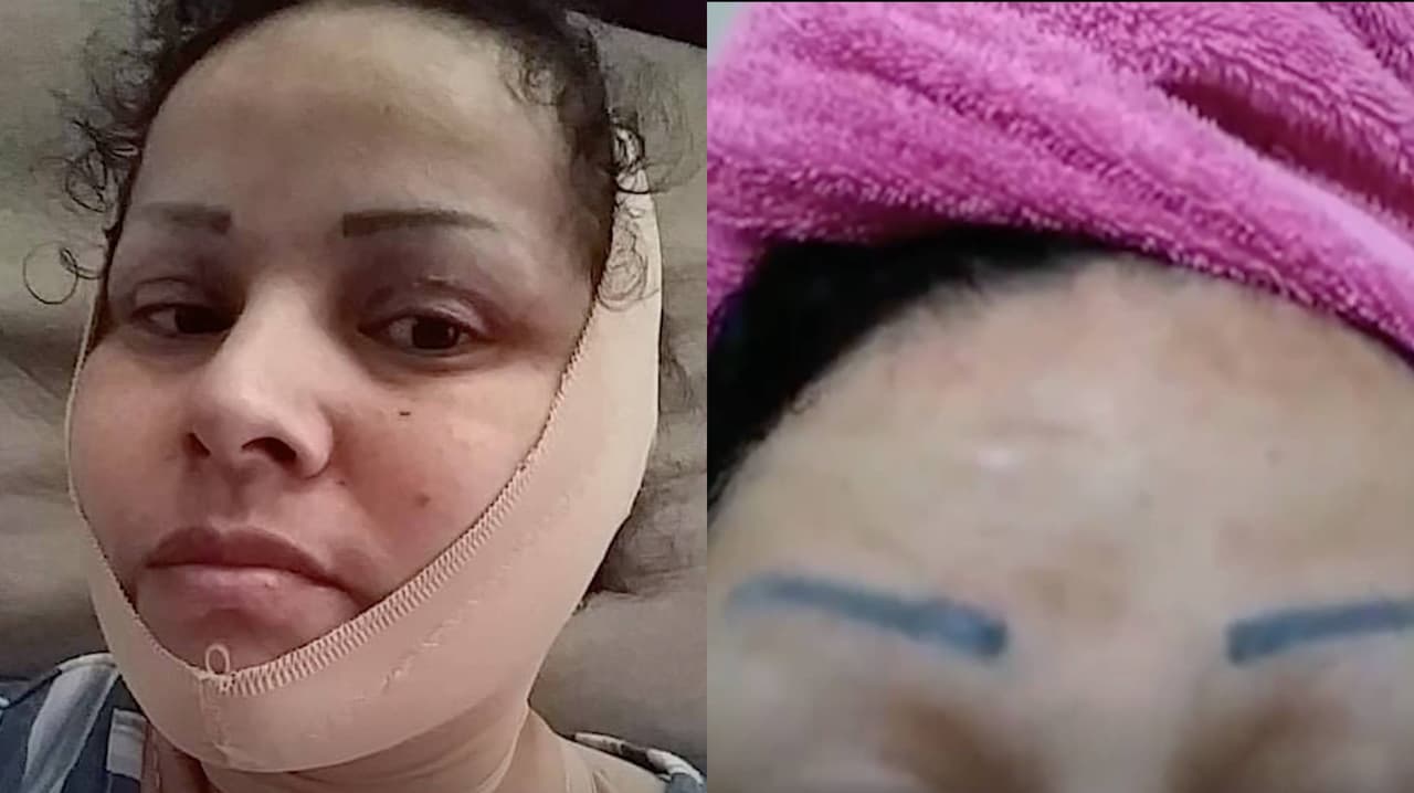 Mujer paga $11,000 por cirugía plástica en Tijuana y aún sufre las consecuencias por los errores que cometieron