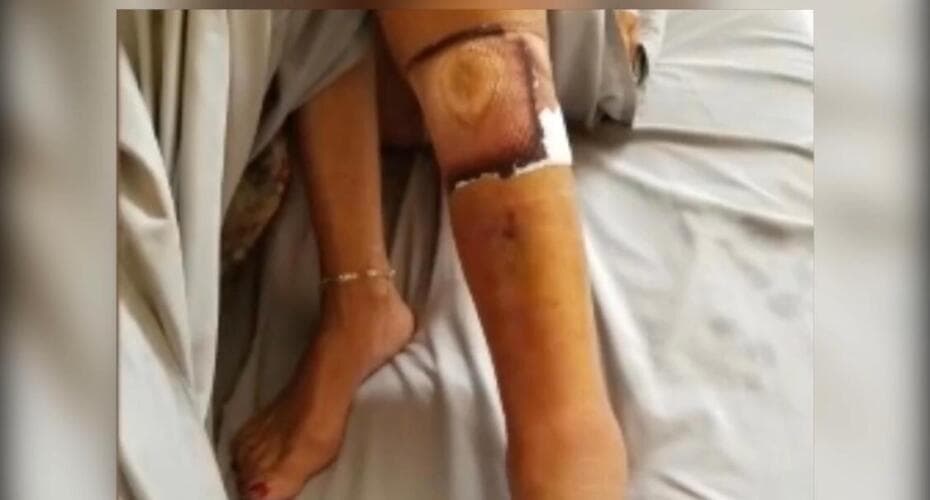 <b>El tratamiento inmediato es crucial para detener la progresión de la enfermedad</b>, ya que los casos graves pueden derivar en la necesidad de cirugía para remover el tejido muerto o infectado.