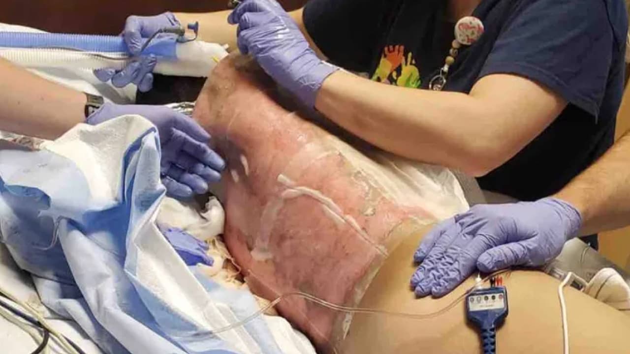 Reto de TikTok deja a un niño de 12 años con graves quemaduras y conectado a un respirador