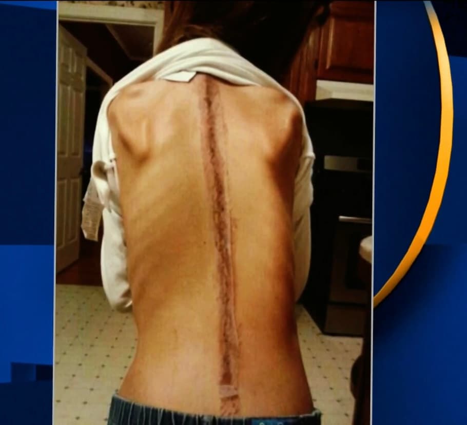 Así, madre e hija decidieron emprender un viaje a los 
<a href="https://www.univision.com/temas/estados-unidos-de-america">Estados Unidos</a> para buscar la ayuda necesaria. A pesar de que un doctor le colocó a la niña una barra de titanio en su espalda para poder enderezarla, 
<b>no le daban más de tres meses de vida </b>debido a que su escoliosis le presionaba su corazón y pulmón. 
<br>