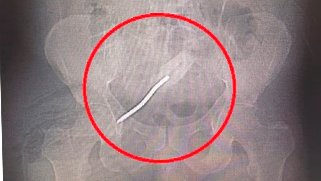 Médicos extraen un destornillador del recto de un hombre en el hospital Kendall Regional 