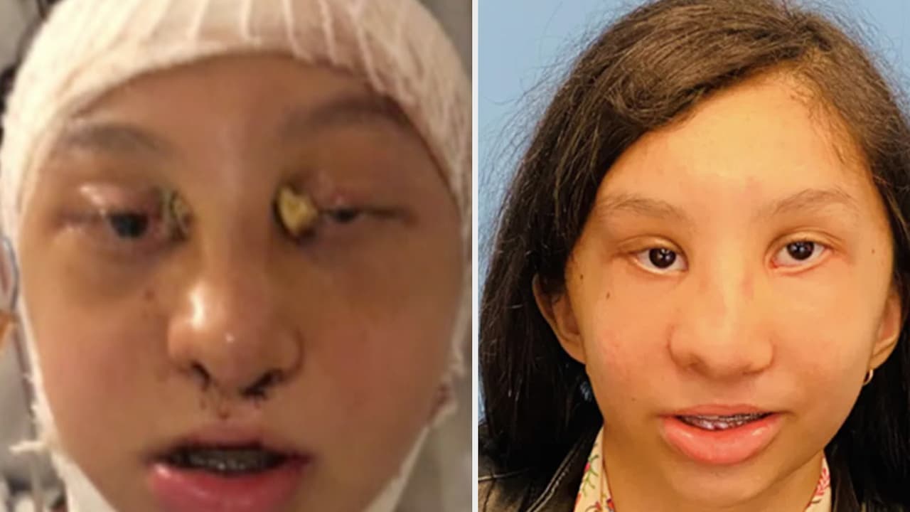 "Le abrieron el cráneo completamente": familia hispana cuenta cómo su hija logró tener un nuevo rostro