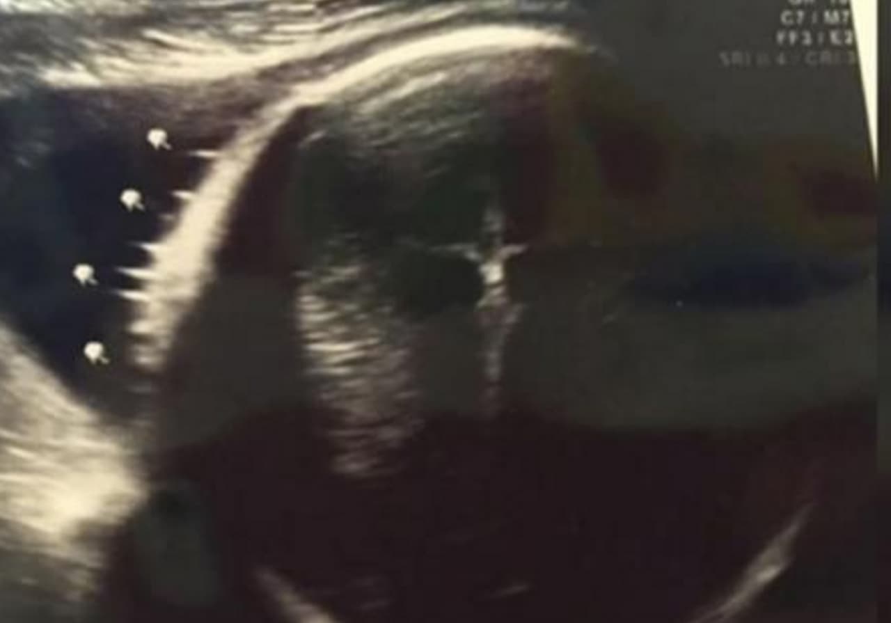 Futura mamá ve a Jesucristo crucificado en ecografía de su bebé