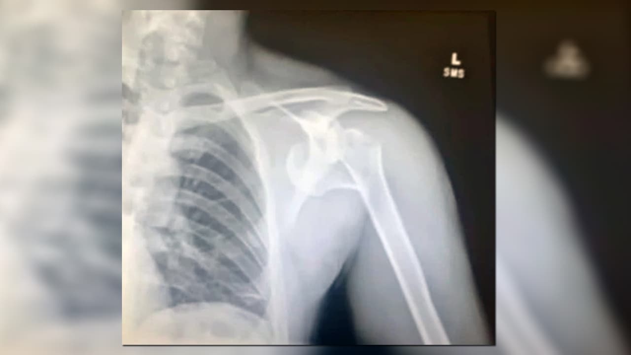 Dustan lleva una articulación artificial y pide ayuda en línea para pagar las cuentas.