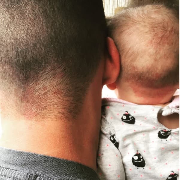 Después de cinco meses del nacimiento de Lua, Zuria se enteró que heredó el lunar de Alberto Guerra y él publicó el siguiente mensaje en Instagram: "Normal, te rapas y tu mujer se da cuenta que tu hija y tú tienen el mismo lunar".