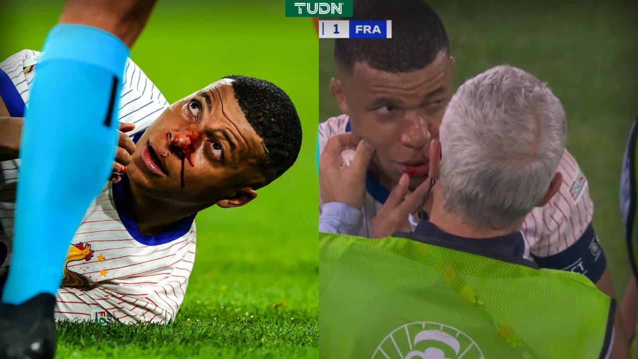 ¿Alarmas en Francia? Mbappé sale con la nariz desfigurada por golpe