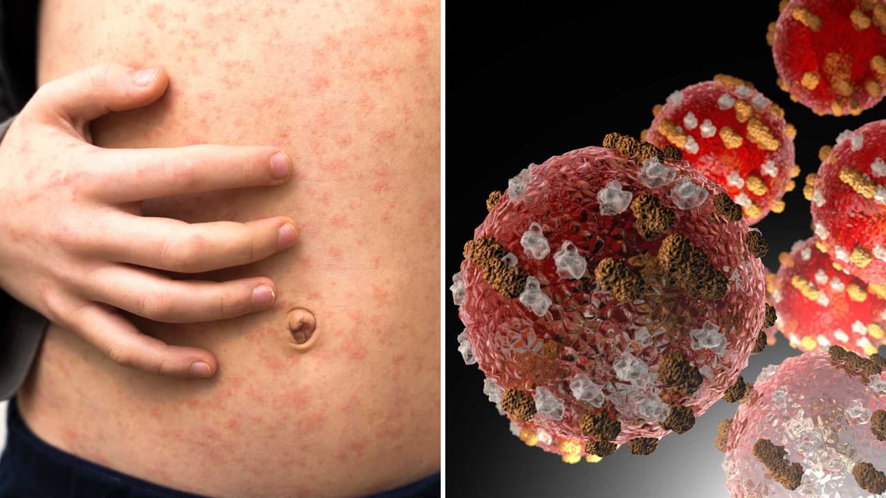 Detectan caso de sarampión en viajero en el condado de Los Ángeles