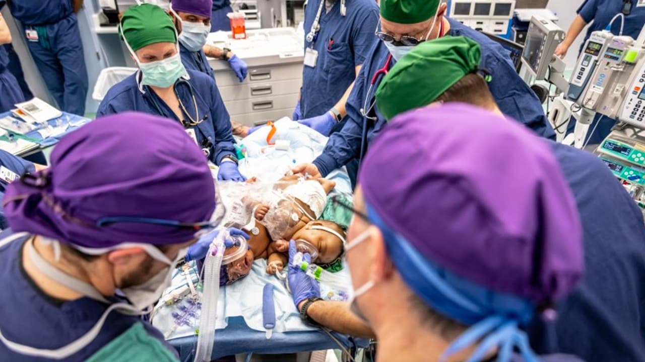 Parte del equipo médico del Cook Children´s en el norte de Texas, se preparan para separar a las siamesas Lynn el 23 de enero del 2023.