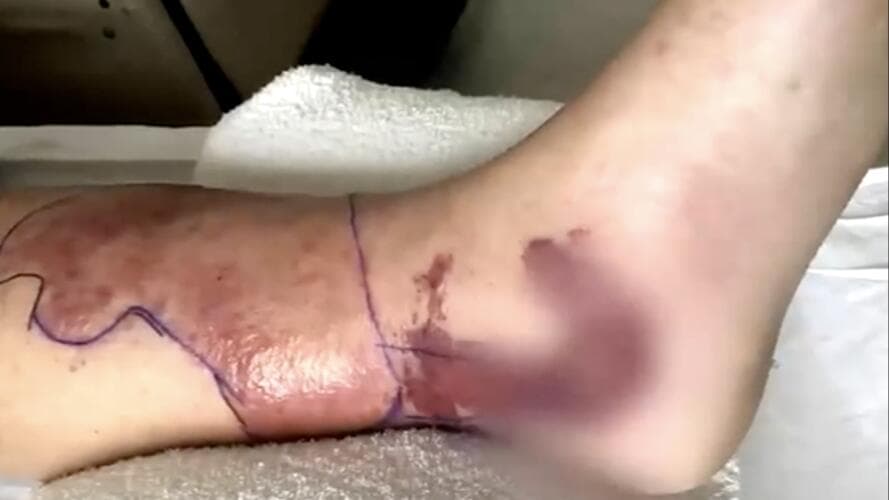 <b>Los síntomas iniciales de la infección incluyen <a href="https://www.univision.com/local/miami-wltv/alerta-bacteria-come-carne-florida-sintomas-y-como-puedes-prevenir-infectarte">fiebre, dolor intenso y enrojecimiento</a> </b>en la zona afectada. Si la infección avanza, puede provocar la muerte de los tejidos cercanos y requerir amputaciones.