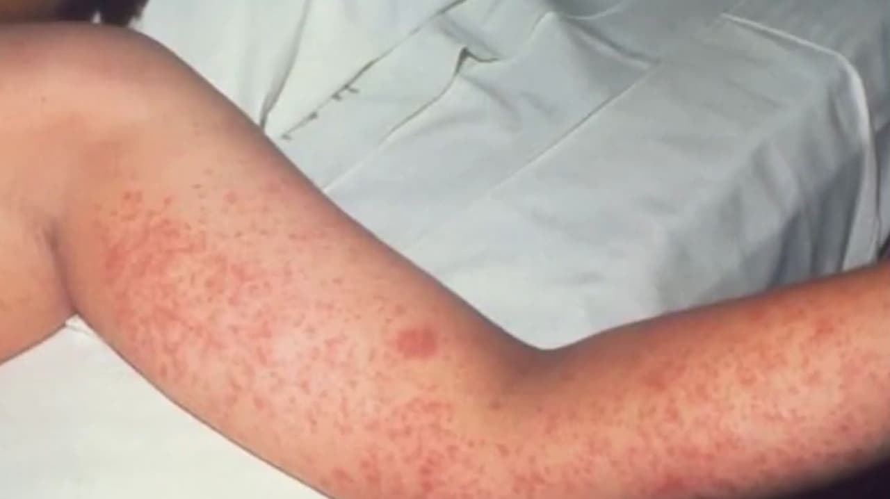 Rebrote de sarampión en EEUU: ¿Cuál es la población más vulnerable por esta enfermedad?