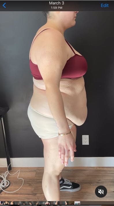 <b>"La piel no se redujo"</b>, admitió y por eso recurrió a la abdominoplastia. 
<br>