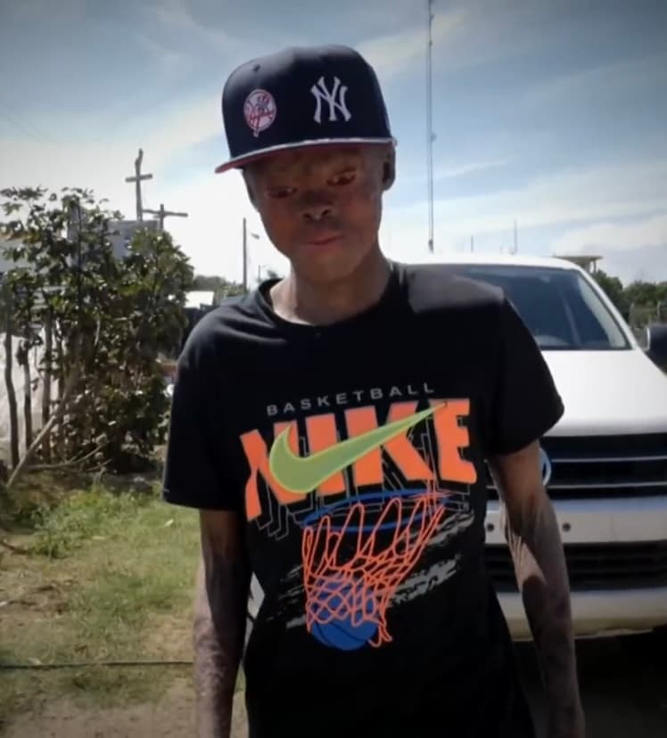 Por si fuera poco, a pesar de que el sol y el calor le hacen mucho daño a su piel, Estévez ha tenido que conseguir trabajo en el sector de la construcción para ayudar a su madre, quien se gana la vida limpiando casas. 
<br>