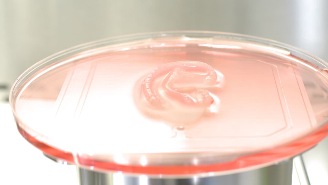 Para crear el implante, los médicos realizaron una biopsia en la oreja de la paciente y extrajeron los condrocitos (las células que crean el cartílago). Luego lo mezclaron con una sustancia que contiene colágeno.