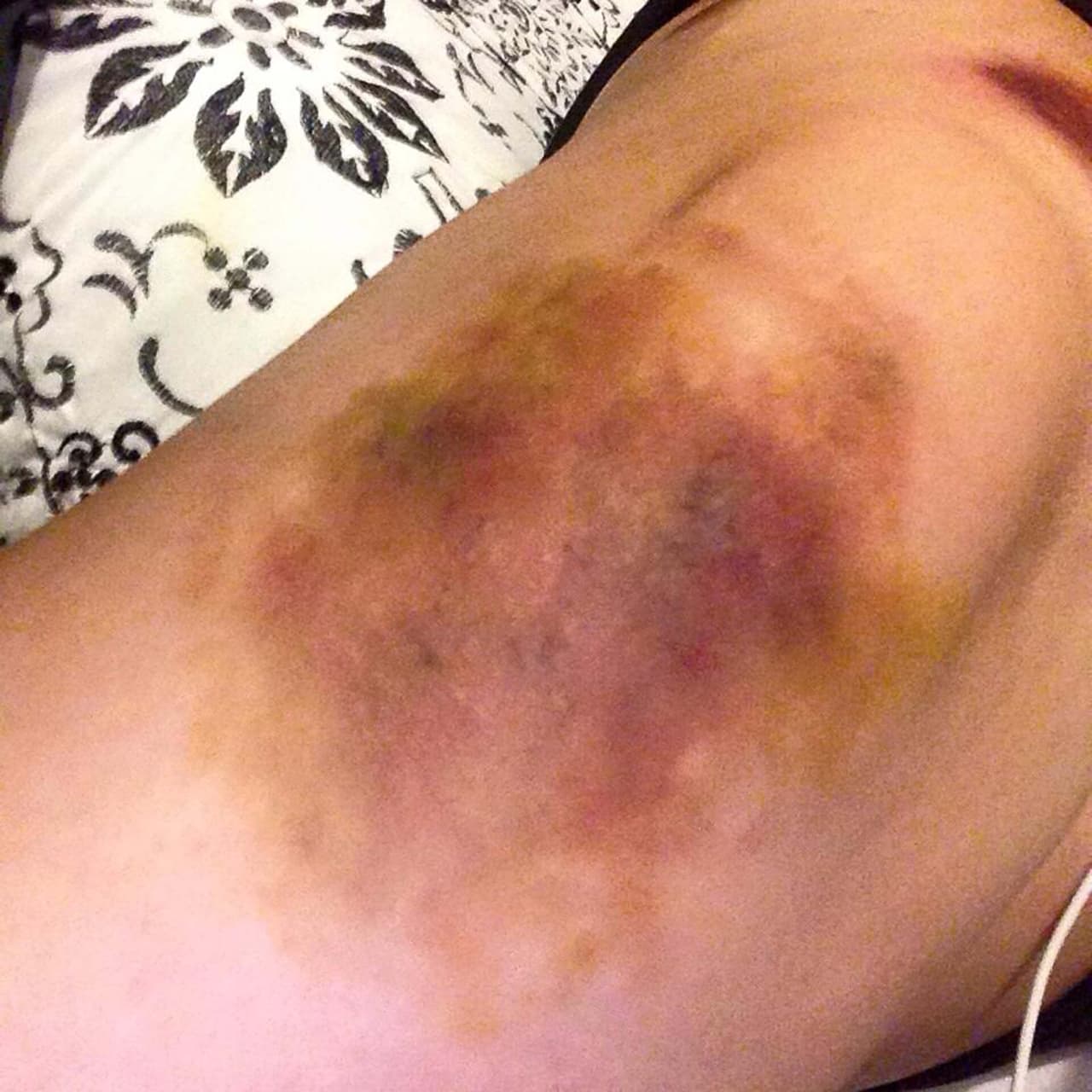 La jovencita es capaz de recrear a la perfección moretones y heridas.