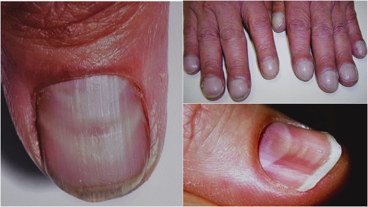 "Las uñas son la ventana al cuerpo": doctor segura que pueden revelar enfermedades