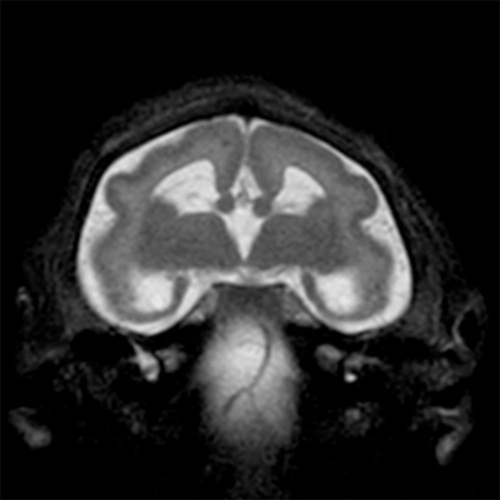 Aunque esto no es común en gemelos, ambos bebés desarrollaron microcefalia severa.