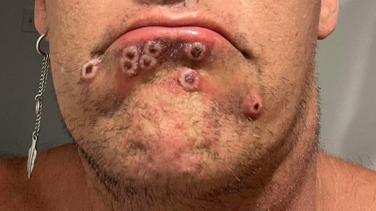 Esta enfermedad es causada por un virus y se le conoce como la 
<a href="https://www.univision.com/local/houston-kxln/confirman-tercer-caso-viruela-del-mono-houston-1" target="_blank">viruela del mono</a> (en inglés monkeypox) la cual se puede transmitir de animales y humanos y de persona a persona.