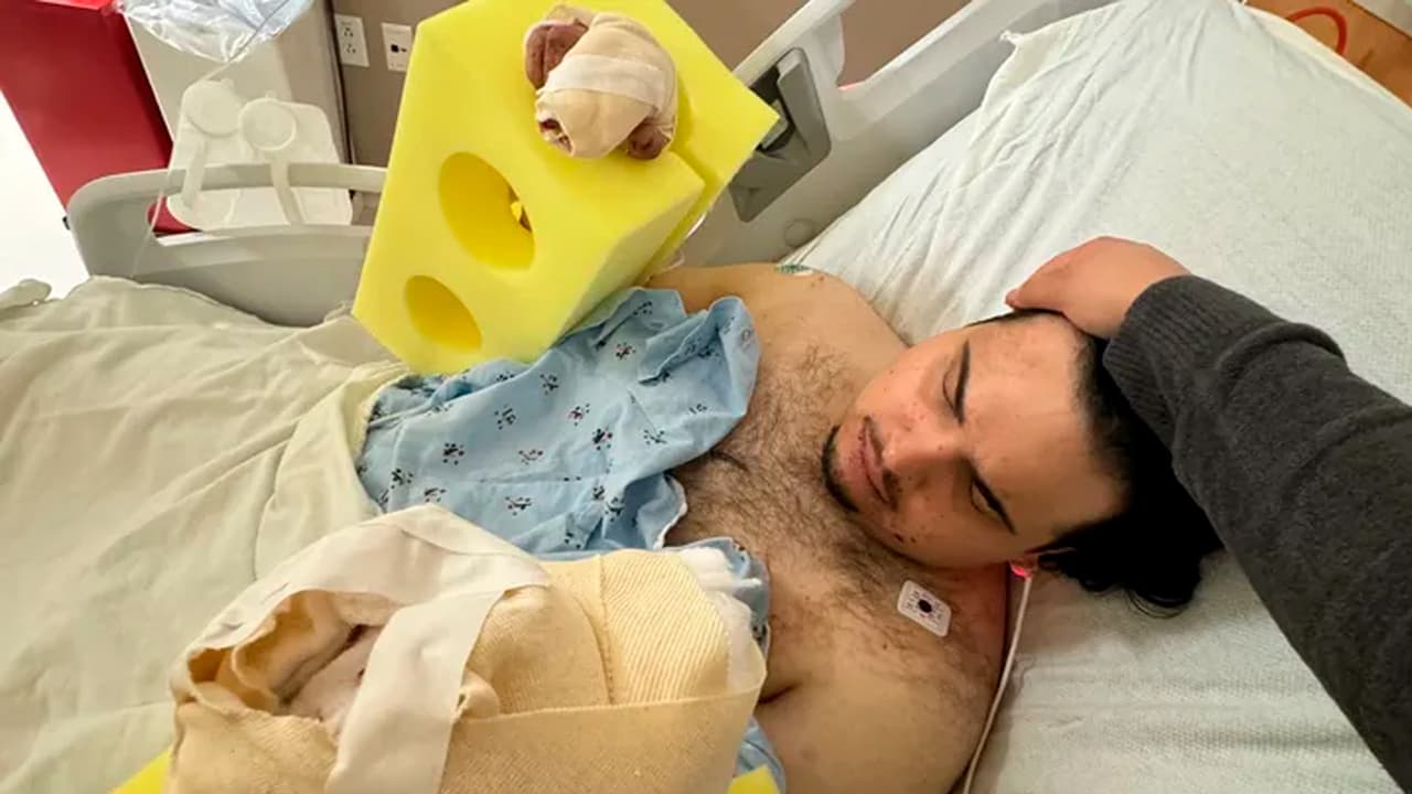 Kevin ahora enfrentará múltiples cirugías reconstructivas.