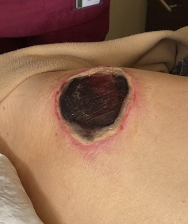 Según el Instituto Nacional del Cáncer de EEUU, las escaras decúbito son una "lesión de un área de la piel causada por presión constante durante mucho tiempo". Esa presión provoca un 
<b><a href="https://www.cancer.gov/espanol/publicaciones/diccionario/def/escara-de-decubito" target="_blank">"daño y destrucción del tejido"</a></b>. La institución señala que los pacientes “que permanecen en una silla de ruedas tienen un riesgo alto" de padecer estas lesiones. La abuela de Thalía y Laura Zapata se vale de una silla para poder moverse con mayor facilidad. 
<br>