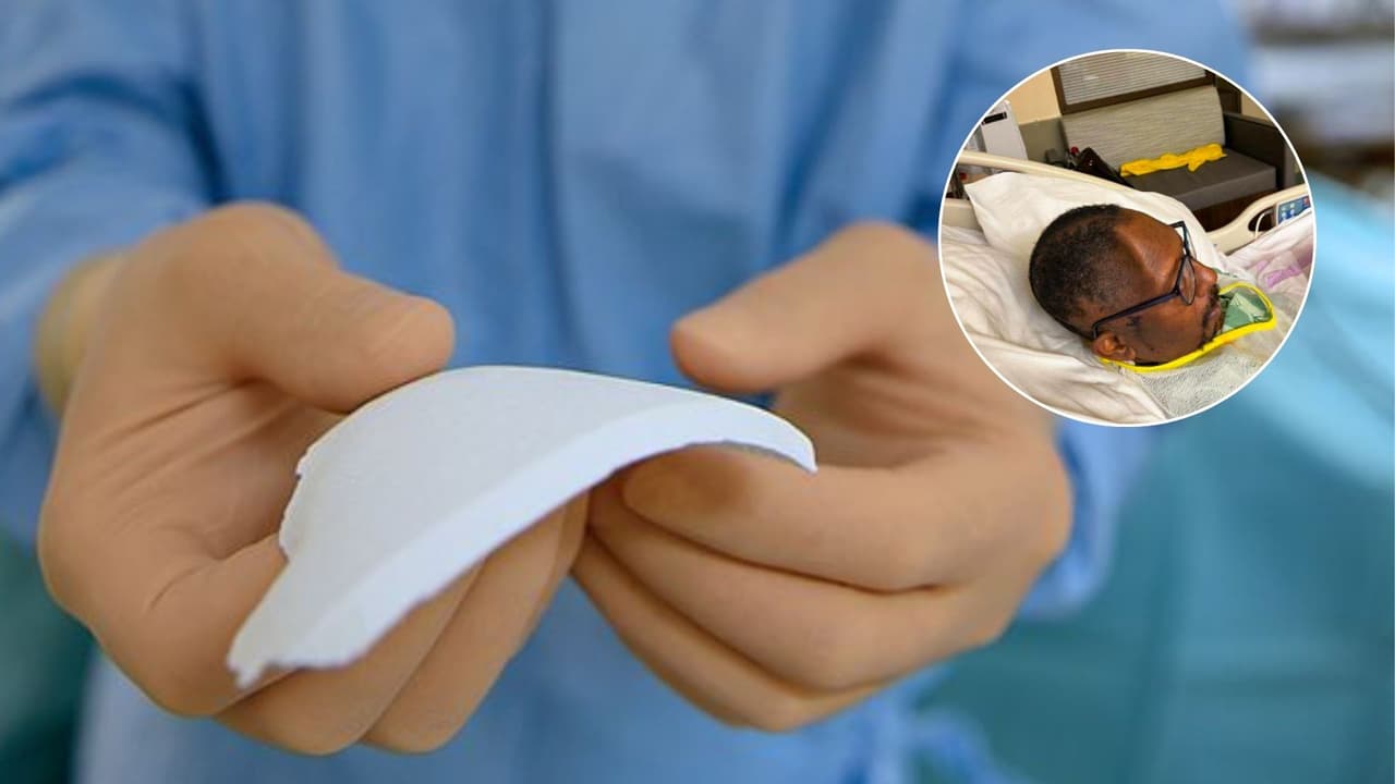 Hospital de Atlanta pierde el pedazo de cráneo que le quitó a un paciente