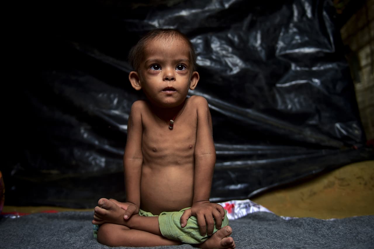 Modina, una niña rohingya de tres años, sufre de desnutrición severa. Vive en un campo de refugiados en Ukhia, Bangladesh.