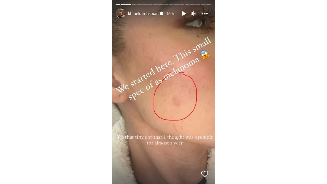 Así lucía el melanoma que Khloé Kardashian tenía en el rostro.