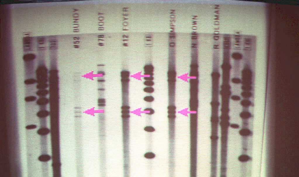 La enfermedad es causada por una
<a href="https://www.univision.com/temas/enfermedades-congenitas">mutación genética</a> en el cromosoma X que provoca el déficit de las proteínas factor VIII (origina la hemofilia A, la más común) y factor IX (hemofilia B), lo cual
<b>impide la coagulación adecuada de la sangre</b>.