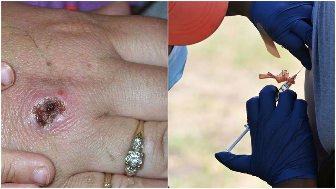 Viruela del mono: se triplican los casos en Long Beach y autoridades anuncian medidas al respecto