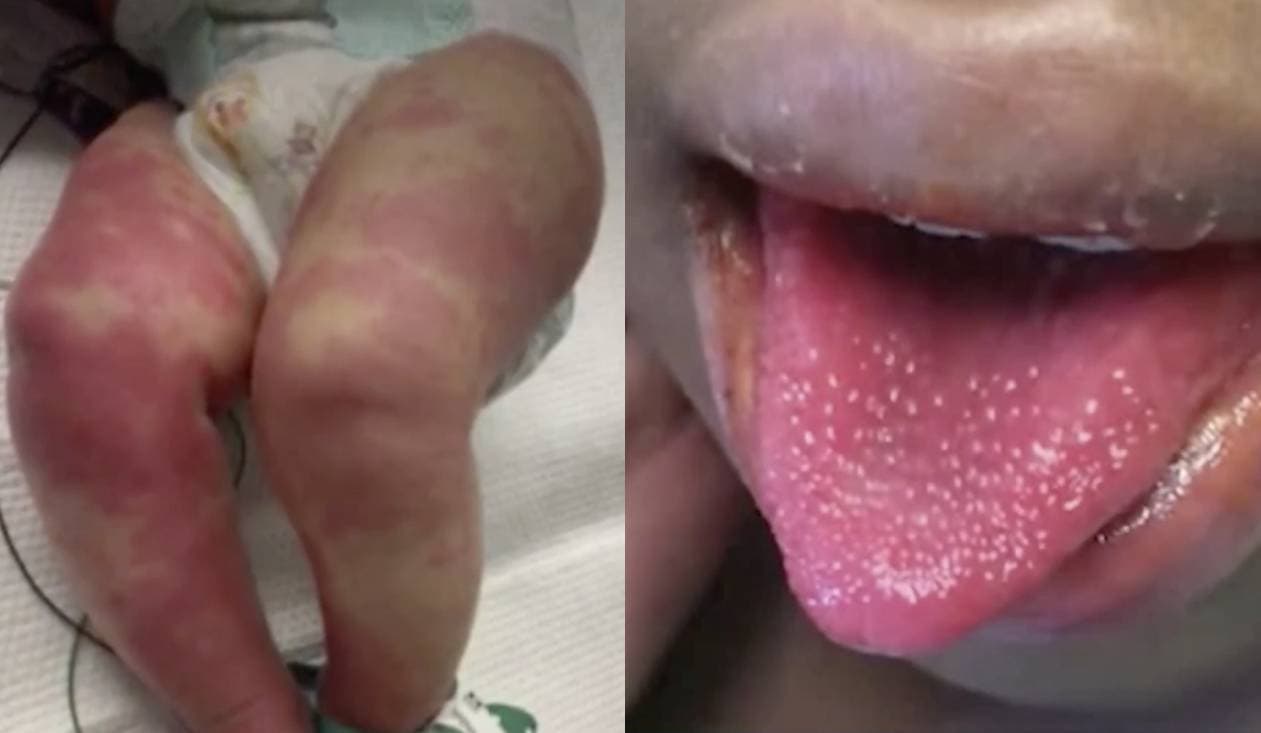 “El Pico de MIS-C viene después del de Covid-19”: pediatras sobre el repunte de casos en niños