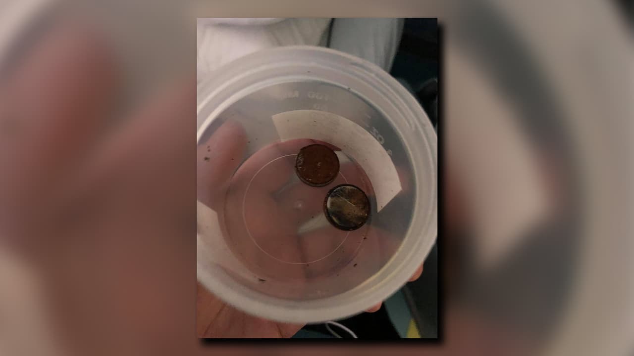 Las pilas liberaron ácido, causando un daño significativo al esófago de Salmina.