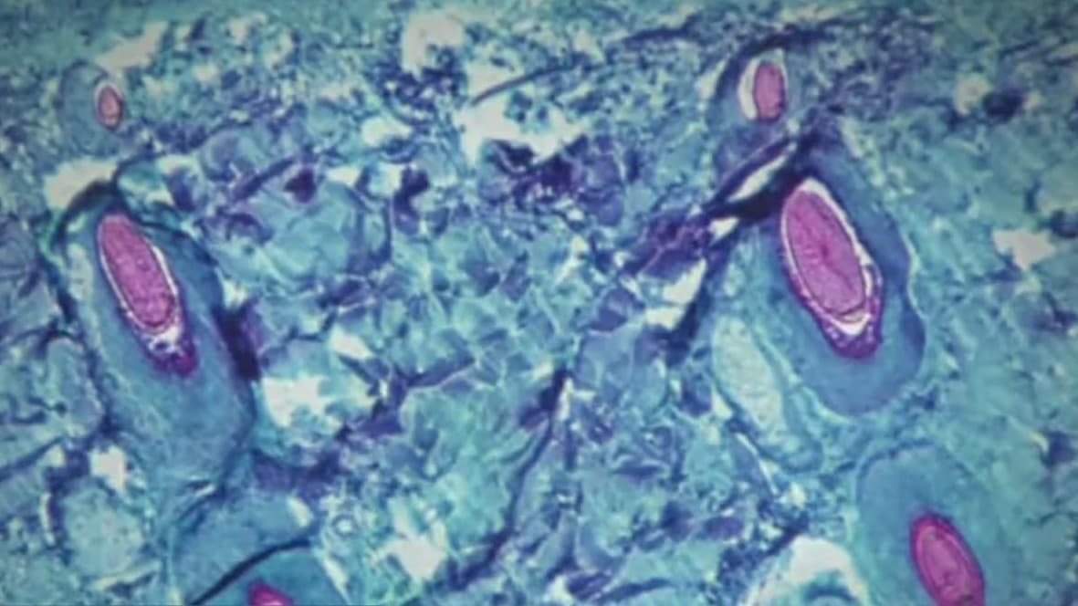 Investigan la muerte de una persona infectada con la viruela del mono en el condado de Los Ángeles