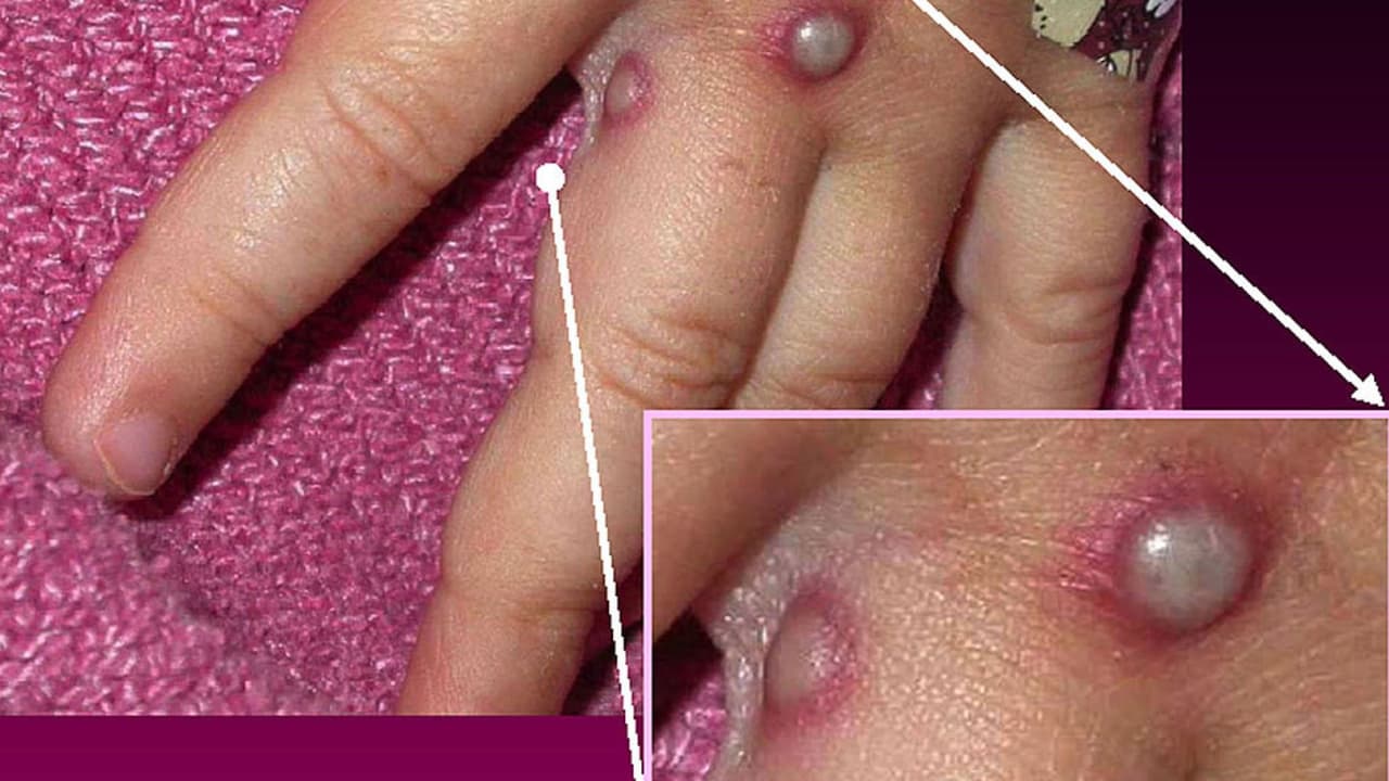 Detectan primer caso de la viruela del mono en Florida Central