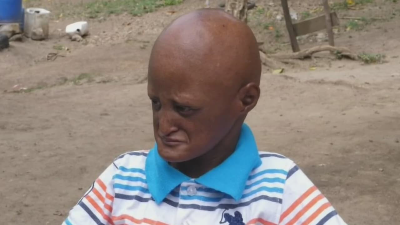 Walmeli es un joven de 23 años que sufre de una enfermedad genética poco conocida en República Dominicana. Nació sin ningún tipo de complicaciones, pero a los dos años su lento desarrollo alertó a los médicos. Después de varios estudios fue diagnosticado con el síndrome de progeria, una rara enfermedad que afecta a los tejidos del cuerpo y produce un acelerado envejecimiento en los niños.