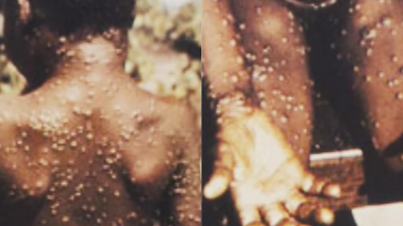 Viruela del mono: ya son 25 los casos reportados en Estados Unidos, uno de estos en Washington DC