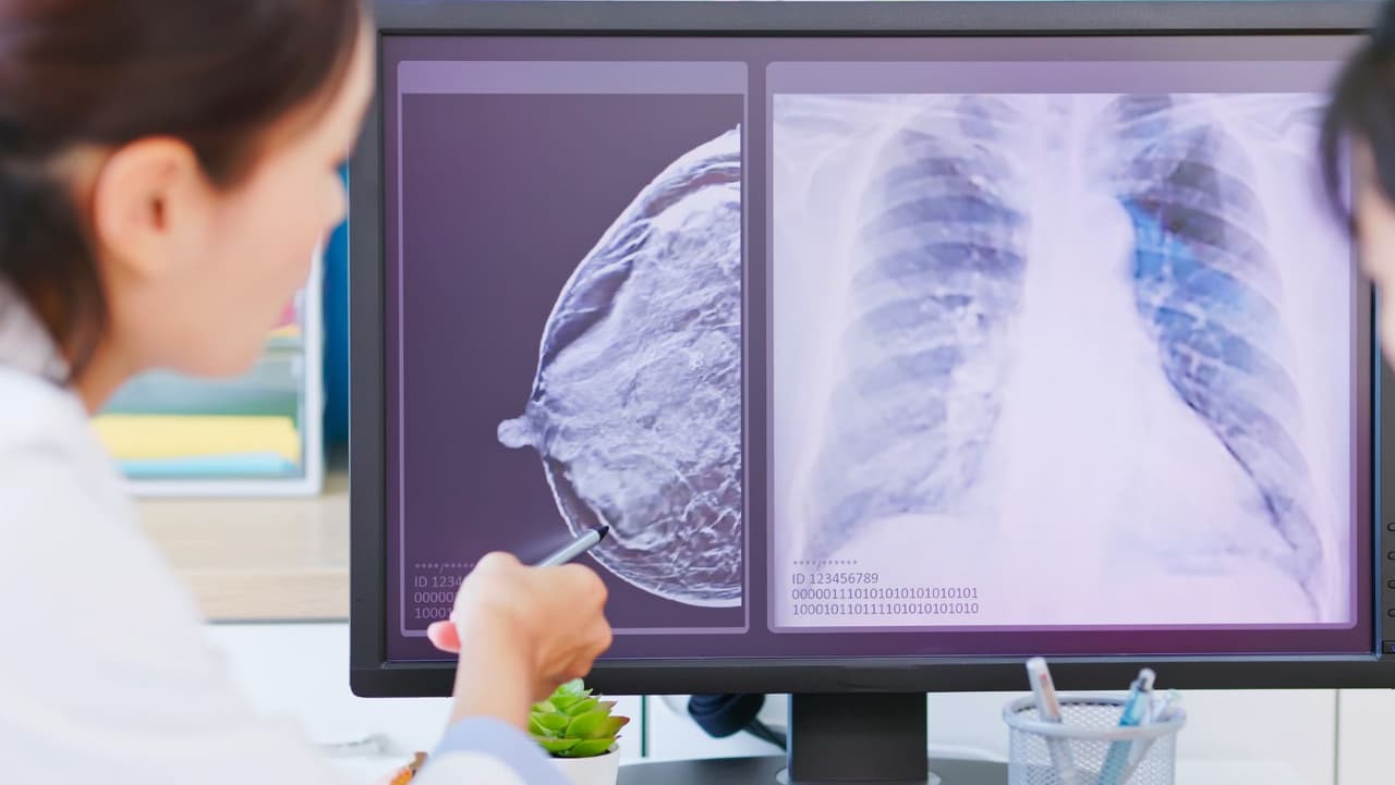 El cáncer de seno es la principal causa de muerte entre las mujeres latinas en Estados Unidos