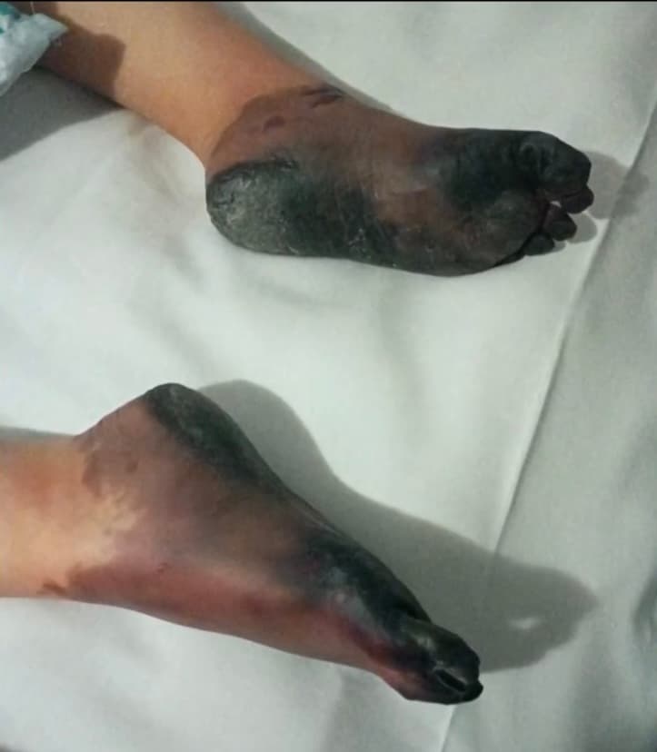 “Yo me veía los pies y les decía que me quitaran las medias porque me están molestando”, recuerda Parada, quien observaba la cara de su hija contrariada al explicarle que no tenía ningunas medias puestas, que si sus pies estaban negros era porque estaban en estado de necrosis. 
<br>