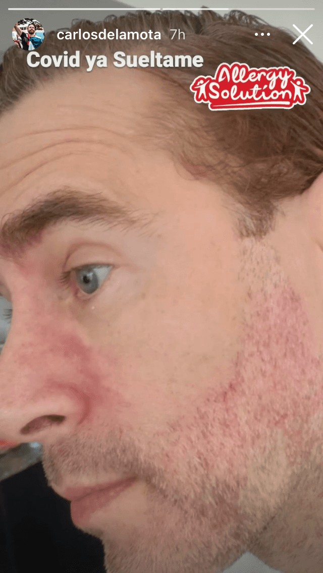 El también arquitecto enseñó la erupción que le salió en gran parte de su cara y que atribuyó al coronavirus. 
<b>"Covid, ya suéltame"</b>, escribió junto a la imagen.