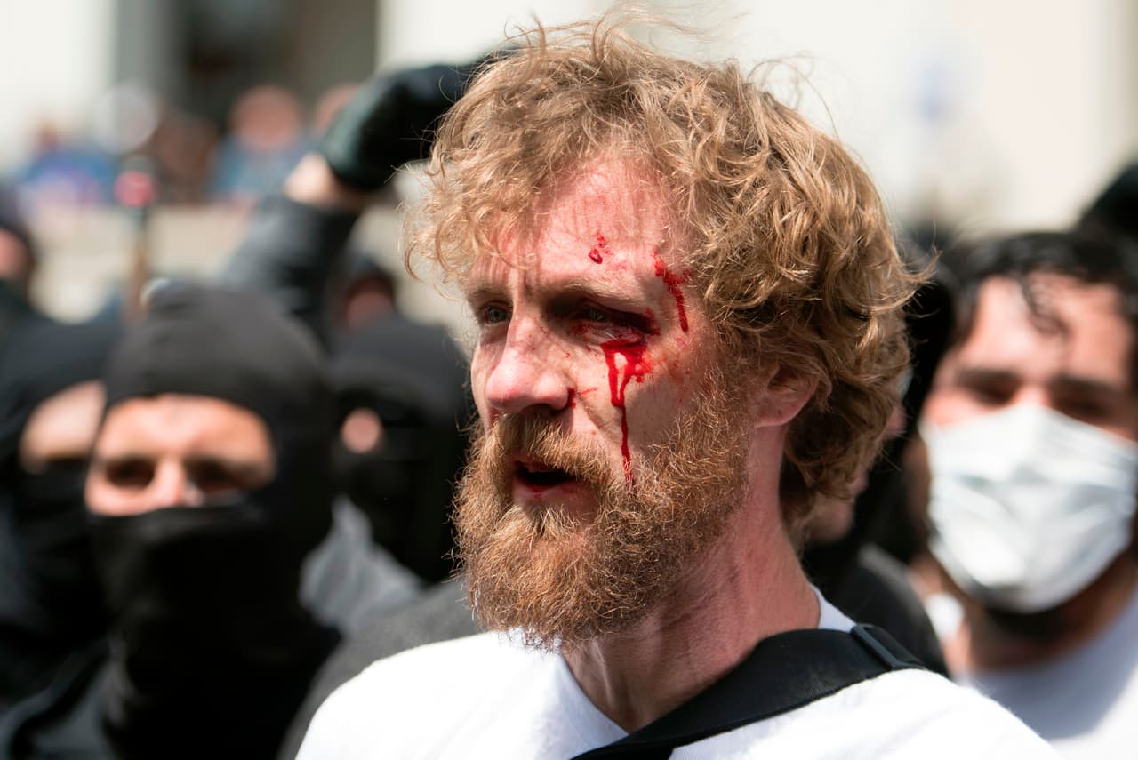La sangre corre por el rostro de este hombre después de que estallaran múltiples pleitos.