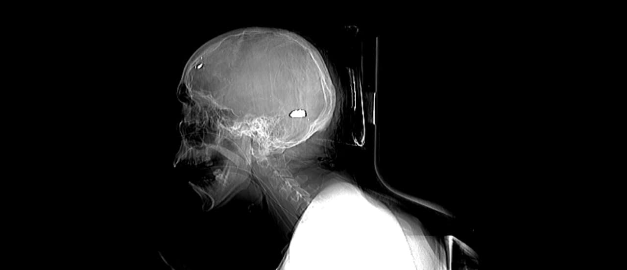 Autopsy reports examined by the IACHR found that "numerous victims were treated for bullet wounds to the head, eyes, neck and chest, as well as to the back, indicating the arbitrary use of lethal force or extrajudicial executions. "