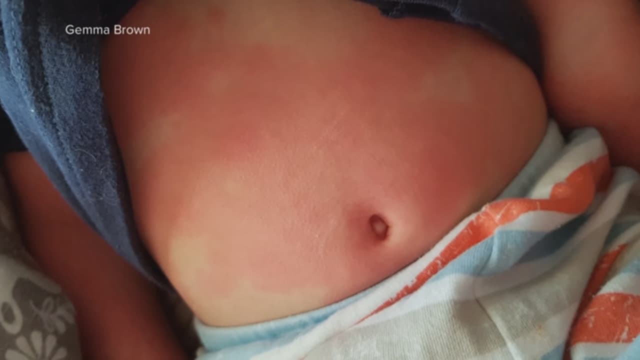 Los síntomas varían entre pacientes, pero además podrían incluir inflamación de las manos y los pies, erupciones en la piel, y shock. En uno de los casos una niña de 12 años de Louisiana sufrió un ataque cardiaco. 
<br>