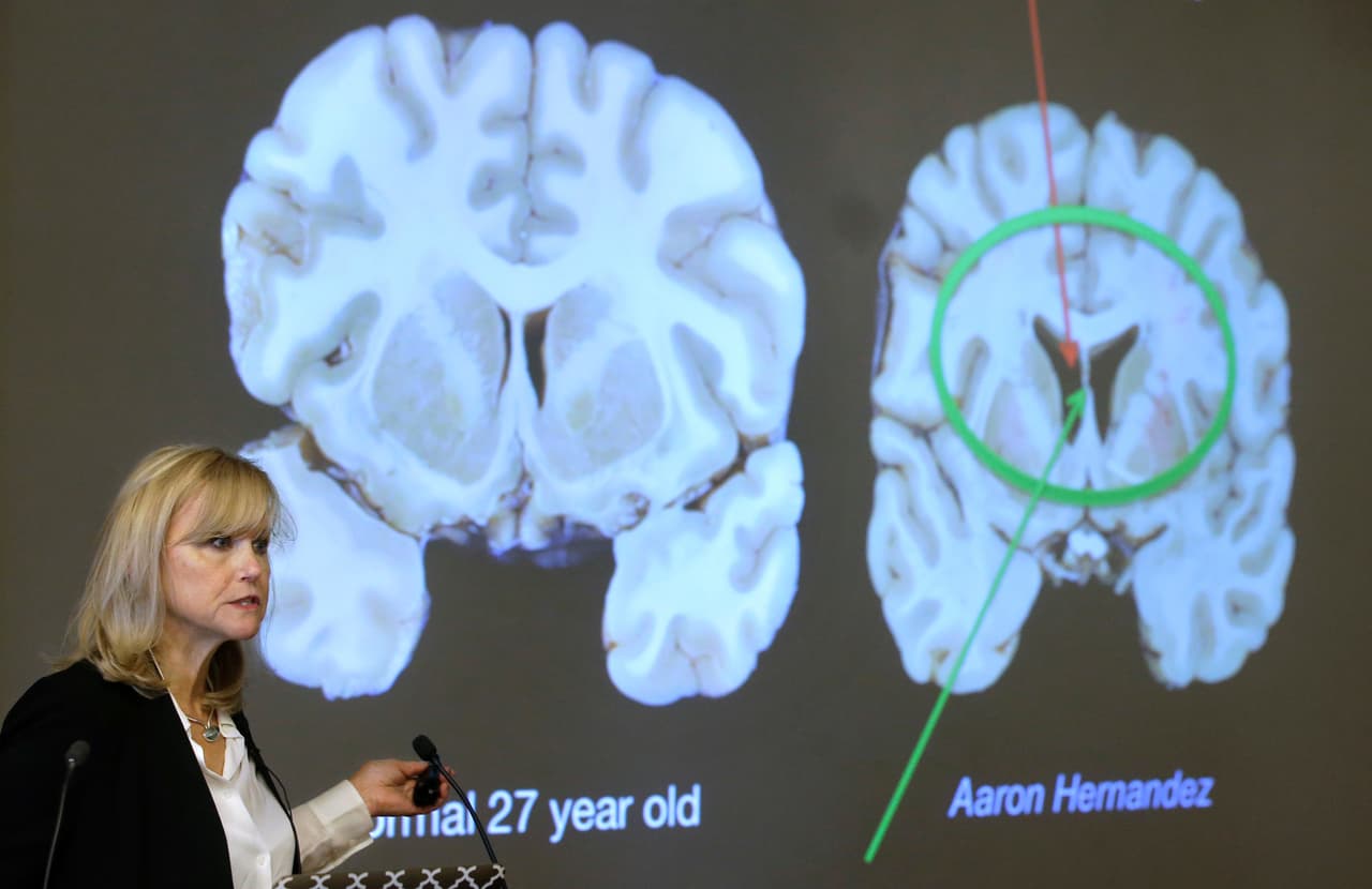 Ann McKee, directora del centro de la Universidad de Boston para la investigación sobre la encefalopatía traumática crónica, habla sobre el estudio hecho al cerebro del exjugador de fútbol americano Aaron Hernández, durante una conferencia realizada el jueves 9 de noviembre de 2017 (AP Photo/Steven Senne)