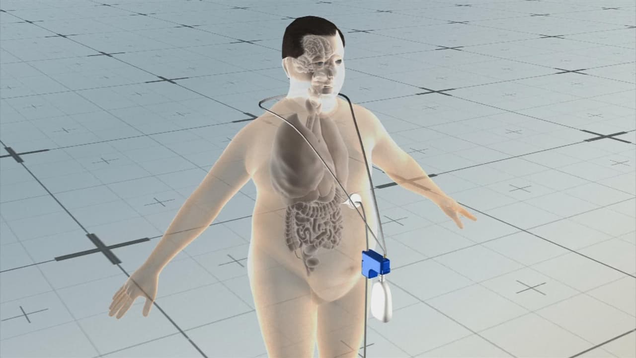 Una sonda que expulsa la comida del estómago y otras aprobaciones recientes de la FDA