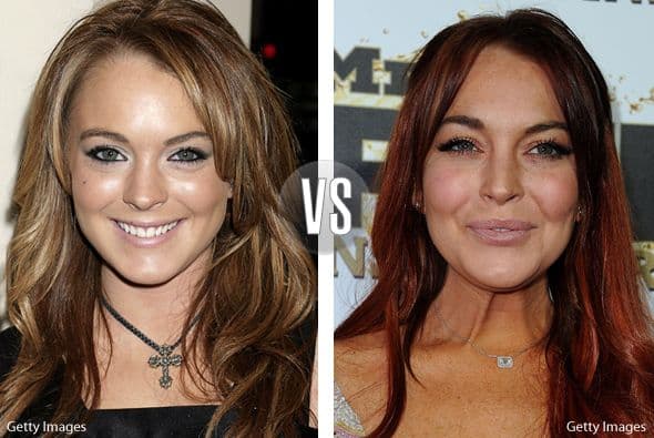 Lindsay Lohan cometió un gran error: se dejó tocar la cara por el bótox y los cirujanos.