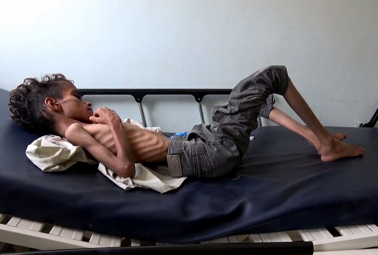 Ghazi Saleh, de 10 años, solo pesa 17 libras (unos 8 kilogramos) y está hospitalizado en Taez, en el suroeste de Yemen. Apenas puede respirar, está demasiado débil para moverse o incluso llorar. La ONU considera que desde que comenzó
<a href="https://news.un.org/es/story/2018/09/1442262">este conflicto han sido asesinadas al menos 16,000 personas.</a>